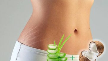 stretch mark treatment with aloe vera and coconut oil