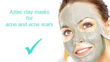 acne treatment with aztec clay