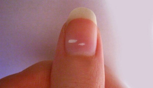 White Spots on Toenails or Fingernails